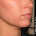 Ultherapy Before & After Patient #1552